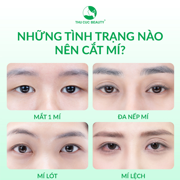 Cắt mí bao nhiêu tiền