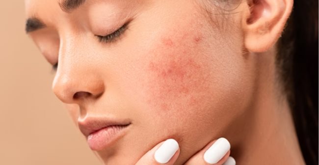 Cách phục hồi da bị dị Ứng mỹ phẩm tại nhà hiệu quả an toàn Cách phục sinh da bị dị Ứng hóa mỹ phẩm tại nhà công dụng an toàn