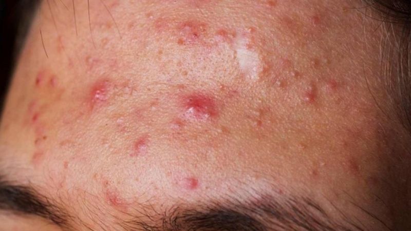 Dị ứng mỹ phẩm đề xuất làm gì Dị ứng mỹ phẩm buộc phải làm gì