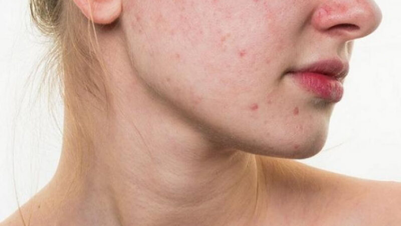 Điểm danh vết hiệu cho thấy thêm bạn bị không phù hợp mỹ phẩm Điểm danh lốt hiệu cho biết thêm bạn bị không phù hợp mỹ phẩm