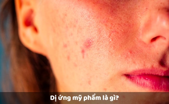 Dị Ứng mỹ phẩm tín hiệu và giải pháp chữa trị Dị Ứng mỹ phẩm dấu hiệu và giải pháp chữa trị