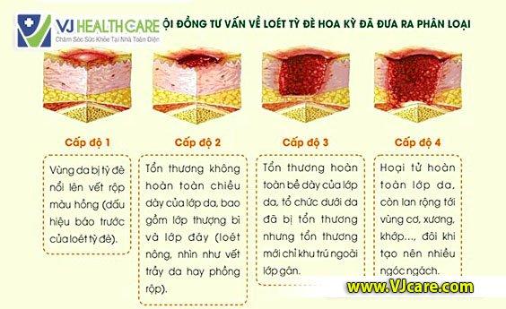 độ loét tì đè với cách âu yếm vết loét tì đè