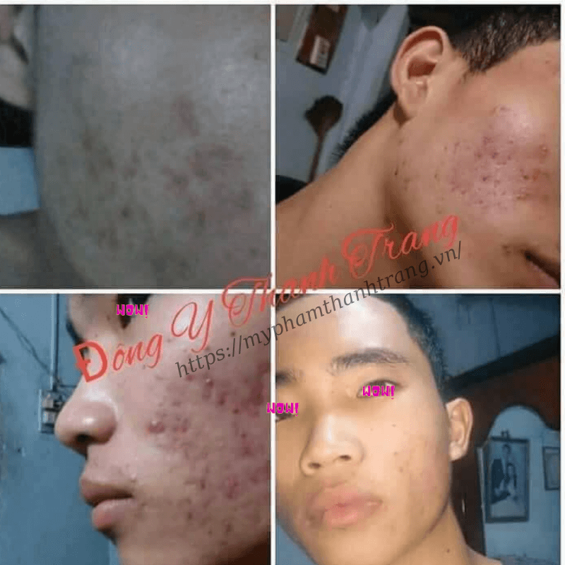 Top hình ảnh feedback cổ truyền đông y trị nhọt thanh trang Top hình hình ảnh feedback cổ truyền đông y trị nhọt thanh trang