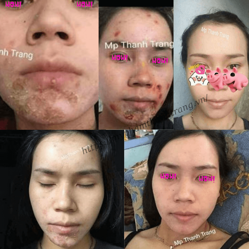 Top hình ảnh feedback đông y cổ truyền trị nhọt thanh trang Top hình ảnh feedback đông y trị mụn thanh trang