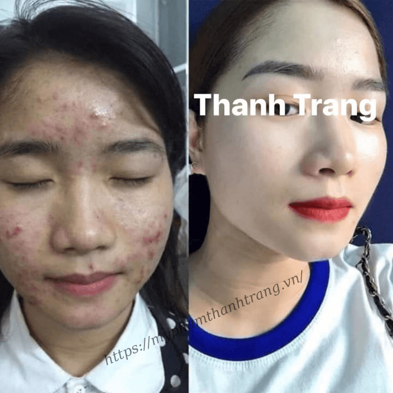 Top hình ảnh feedback đông y trị mụn thanh trang Top hình hình ảnh feedback cổ truyền đông y trị nhọt thanh trang