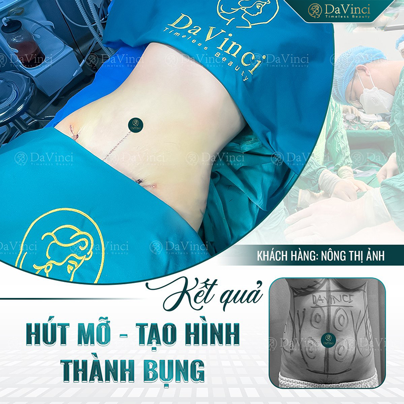 Đánh giá reviews hút mỡ dư thừa tại thẩm mỹ davinci new nhất